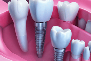 Dental Implants Indications Quiz