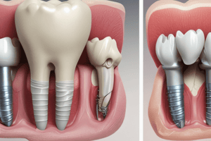 Characteristics of Type 4 Bone in Lekholm and Zarb Classification