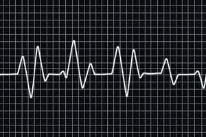 Electrocardiograma (ECG) - Derivaciones