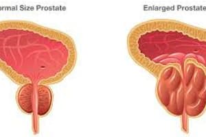 212B Male Reproductive BPH Overview