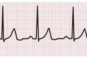 lab 6 - ECG