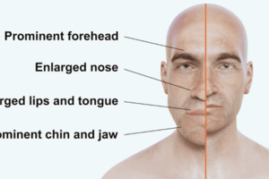 Acromegaly: Overview and Pathophysiology