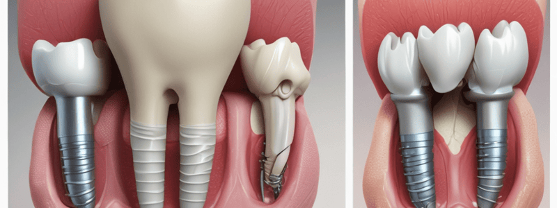 Characteristics of Type 4 Bone in Lekholm and Zarb Classification