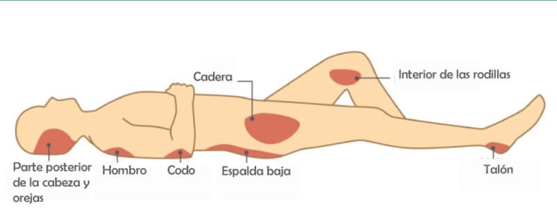 Prevencion ulceras por presion