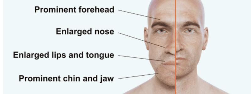 Acromegaly: Overview and Pathophysiology