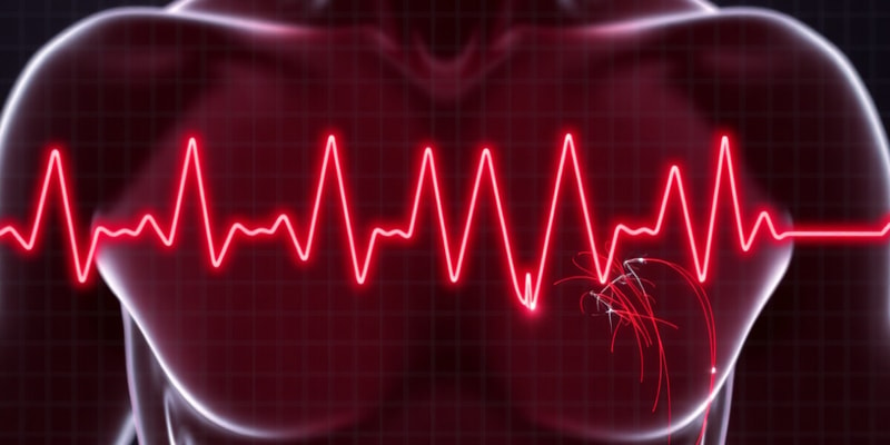 Cardiac Dysrhythmias - Sinus bradycardia