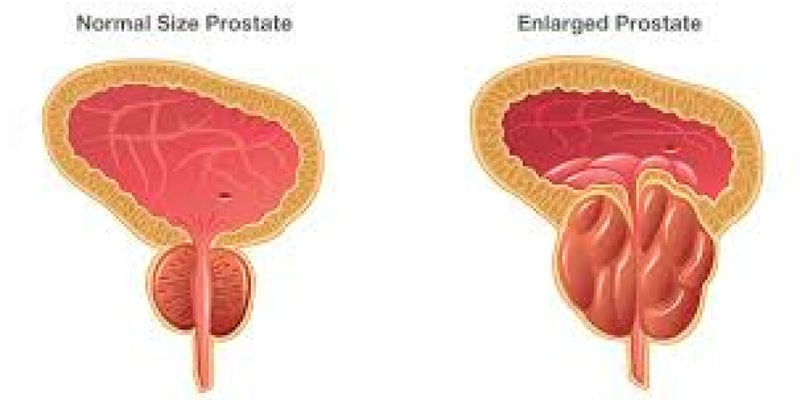 212B Male Reproductive BPH Overview