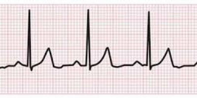 lab 6 - ECG